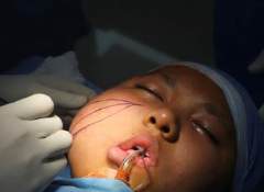 Analysis Of Hemangioma Treatment