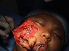 Analysis Of Hemangioma Treatment