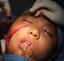 Analysis Of Hemangioma Treatment