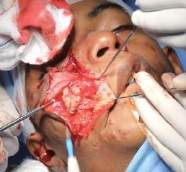 Analysis Of Hemangioma Treatment