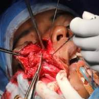 Analysis Of Hemangioma Treatment