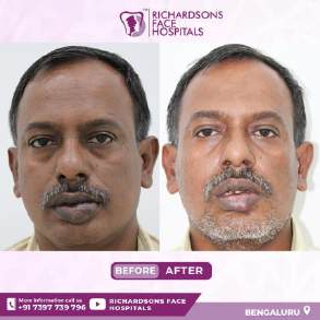 Analysis Of Hemangioma Treatment
