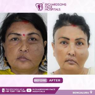 Analysis Of Hemangioma Treatment