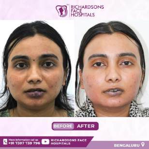 Analysis Of Hemangioma Treatment