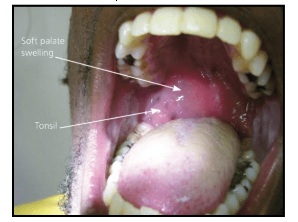 Tonsillectomy blog 1