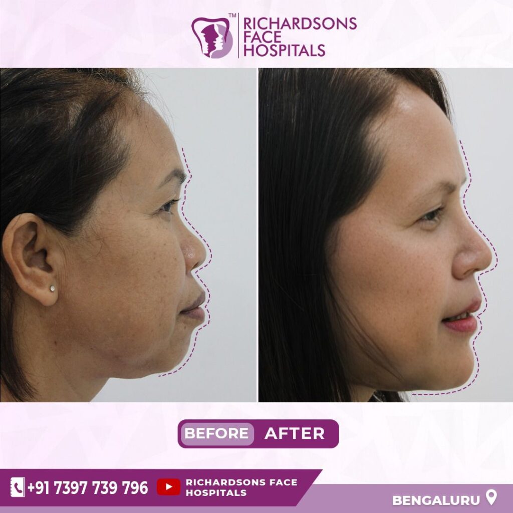 Best Anti-Aging Treatment in Bangalore