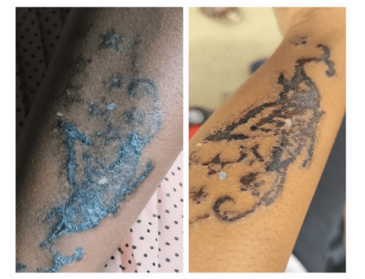 laser tattoo removal