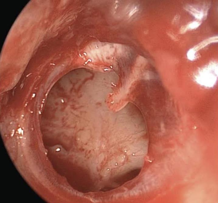 Tympanoplasty blog.pdf image 000