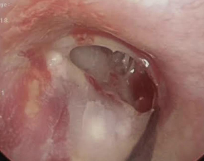 Tympanoplasty blog.pdf image 002