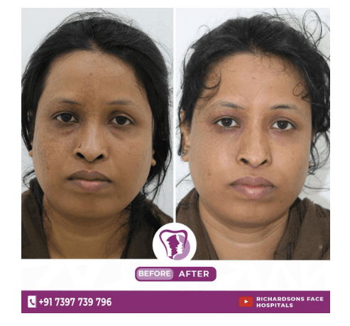 laser birthmark removal2