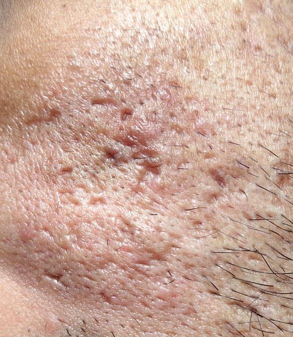 Best Acne scar treatment in Bangalore