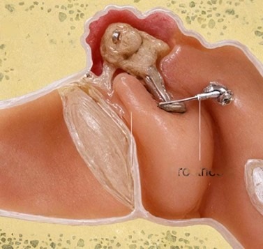 Best ENT Treatment in India