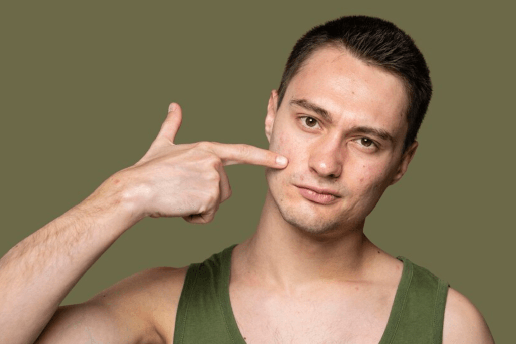 best acne scar treatment