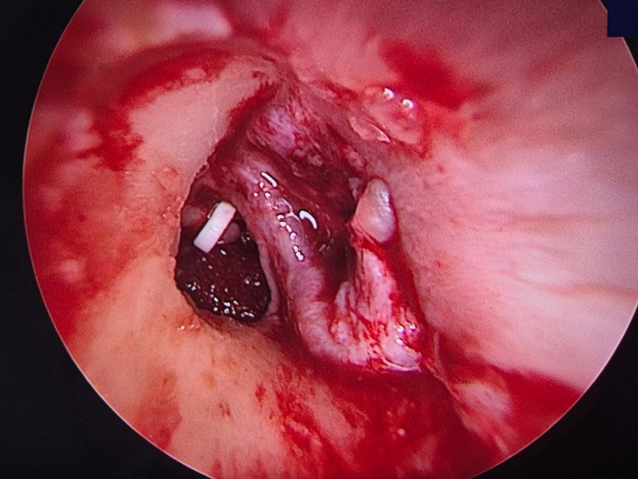 Best ENT Treatment In India