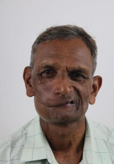 Post-Cancer Facial Reconstruction