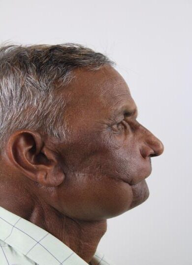 Post-Cancer Facial Reconstruction