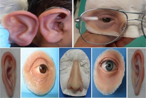 Post-Cancer Facial Reconstruction