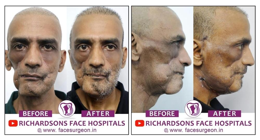 Post-Cancer Facial Reconstruction