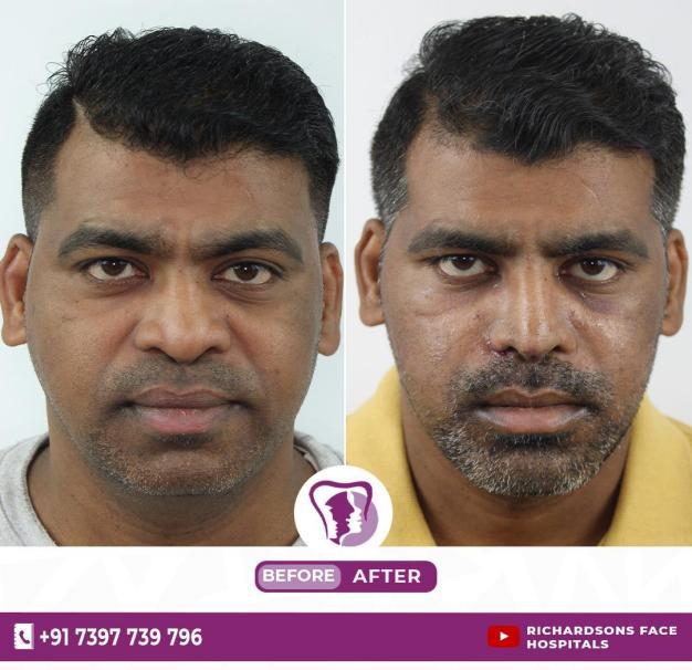BURIED NOSE AND RESURRECTIVE RHINOPLASTY.pdf image 000