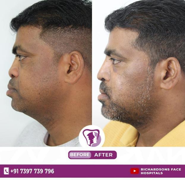 BURIED NOSE AND RESURRECTIVE RHINOPLASTY.pdf image 001