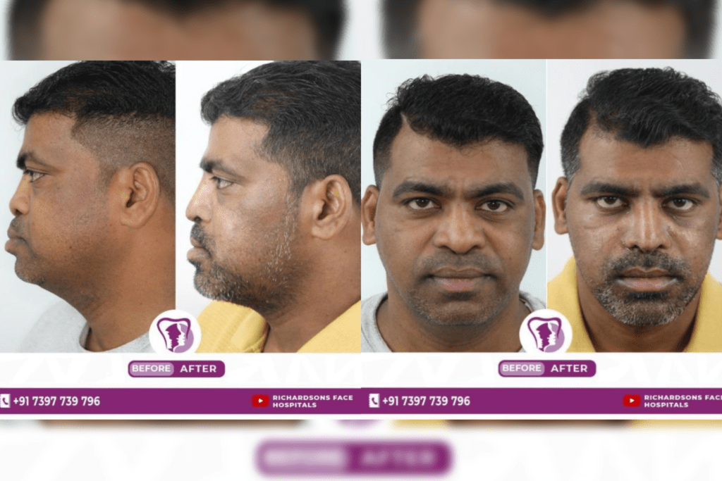 Rhinoplasty Treatment