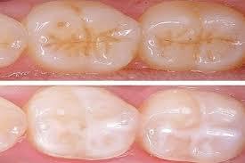 How To Prevent Cavities: Tips For Healthy Teeth