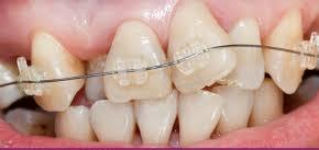 How To Prevent Cavities: Tips For Healthy Teeth