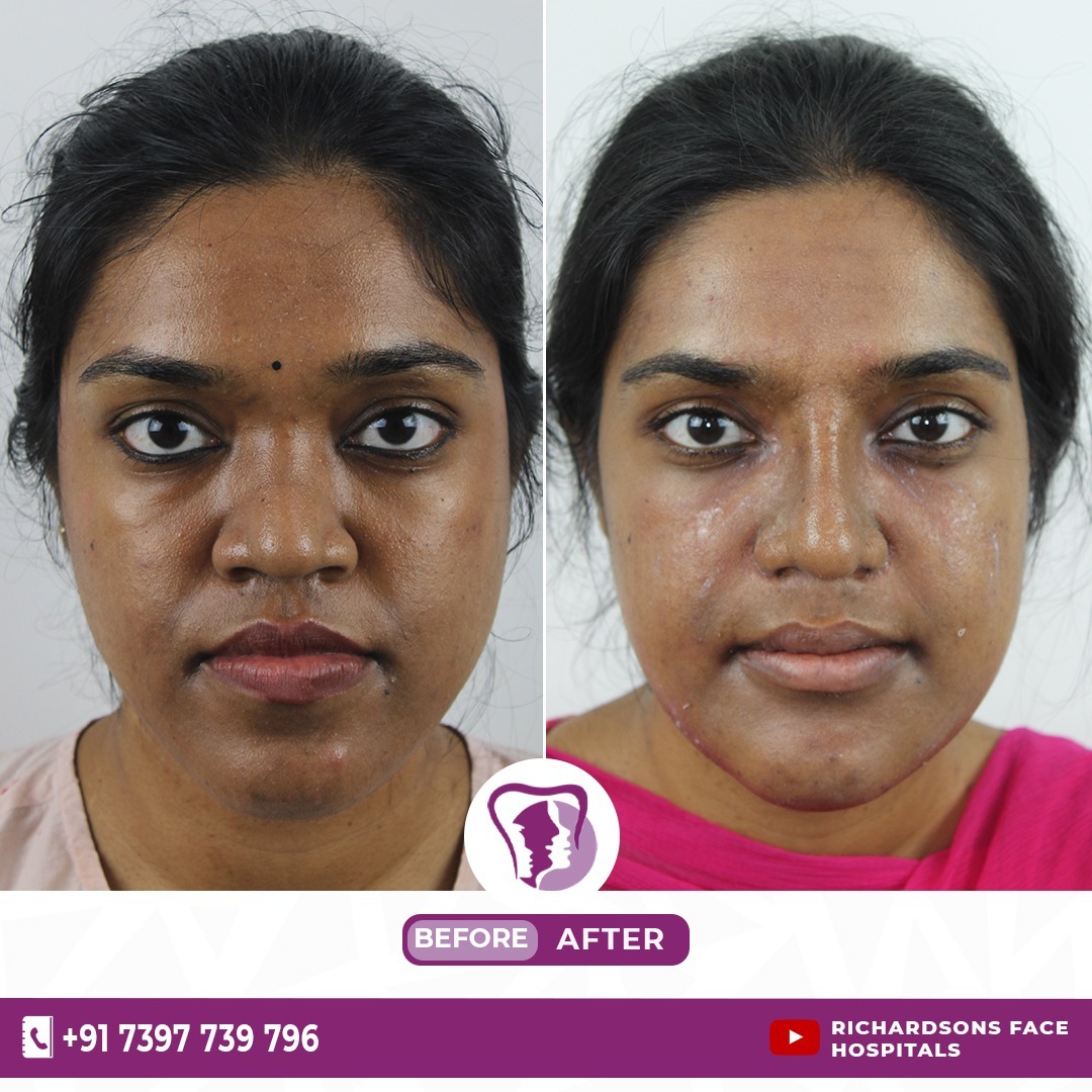 Best Jaw Surgery In India, Best Orthognathic Surgery In India