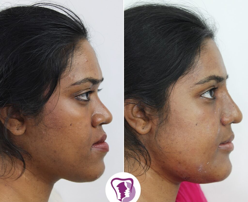 Best Jaw Surgery In India
