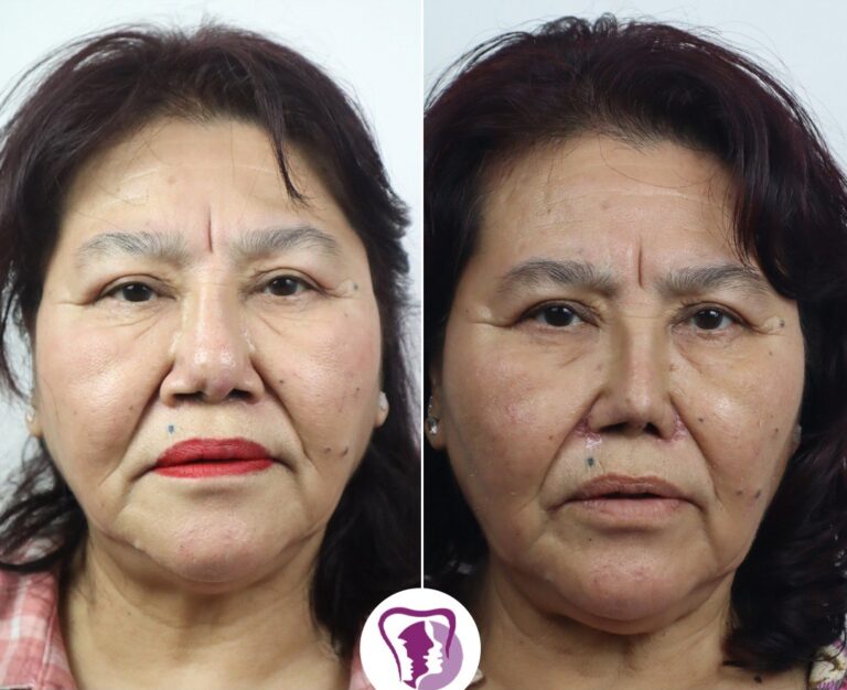 Reduction Rhinoplasty Treatment In Bangalore, India