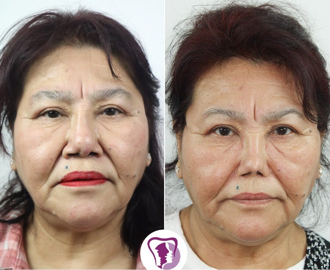 Redo Rhinoplasty Treatment In Bangalore, India