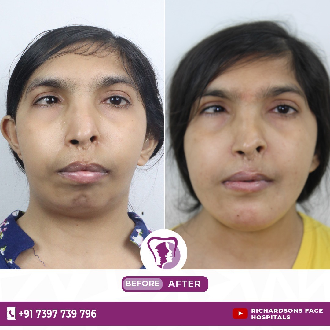 TMJ Reconstruction