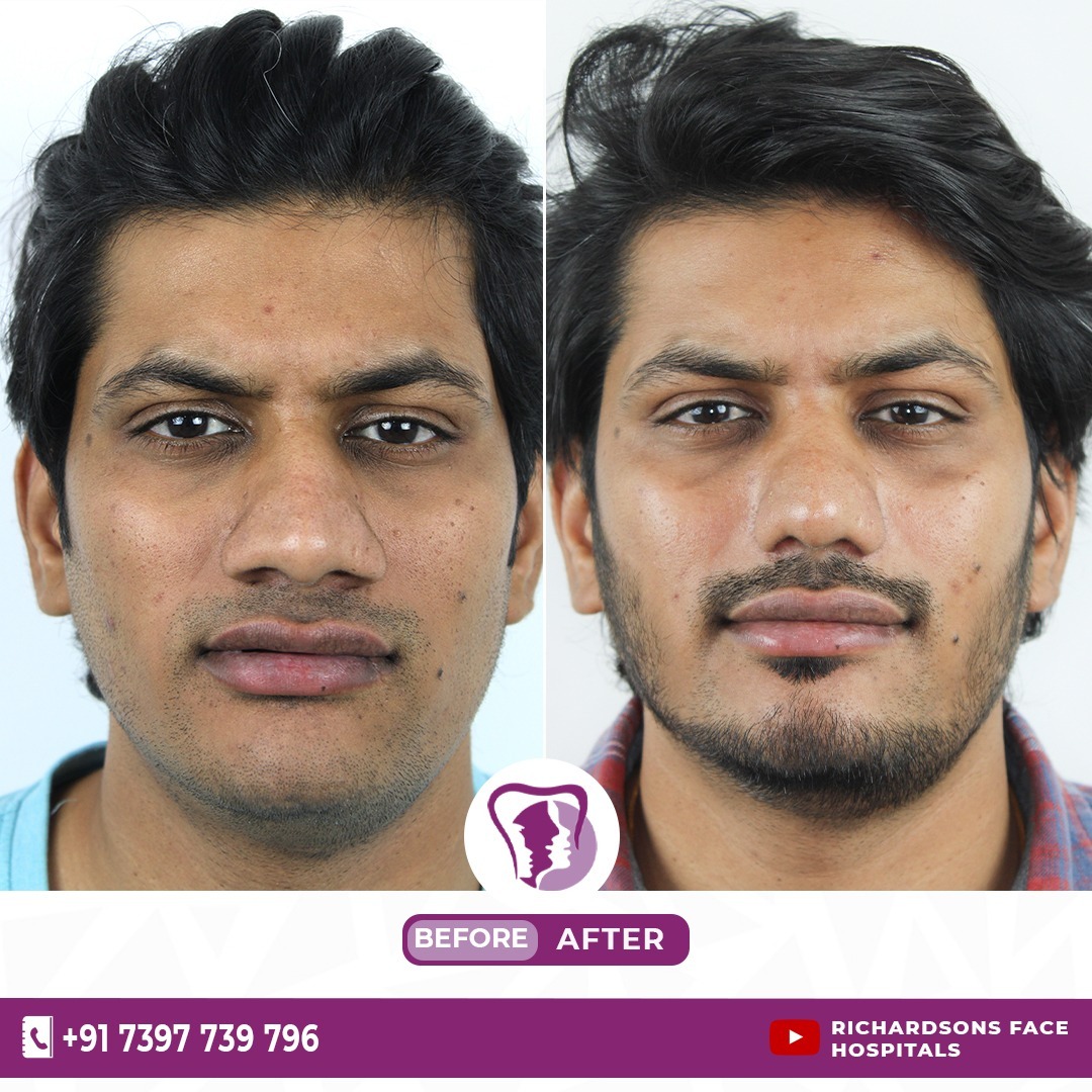 Tip Plasty Rhinoplasty