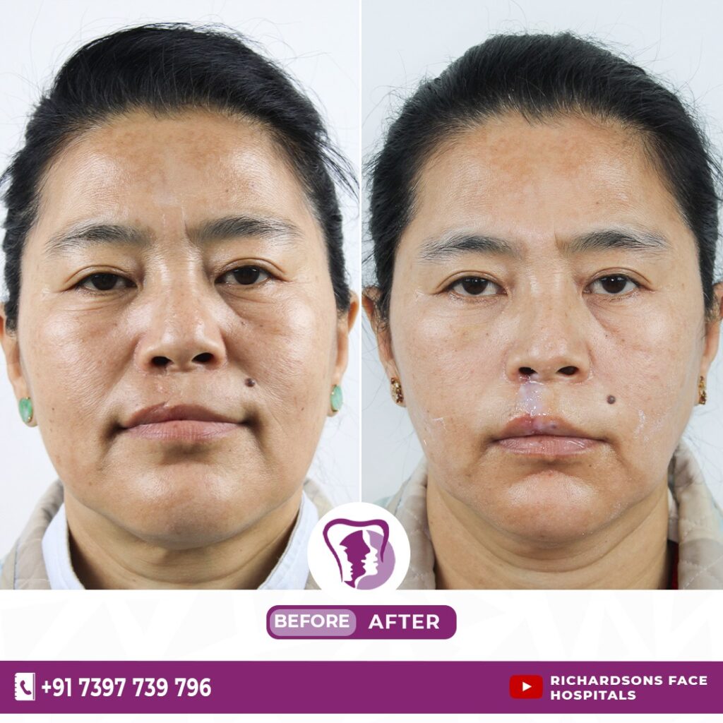 Scar Removal