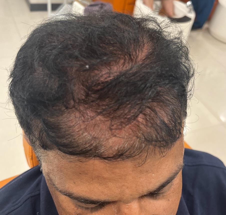 How To Control Hair Fall