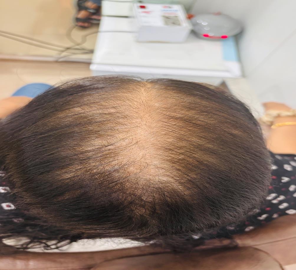 How To Control Hair Fall