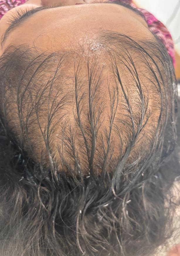 How To Control Hair Fall