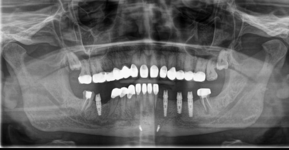 Dental Implants Vs Bridges