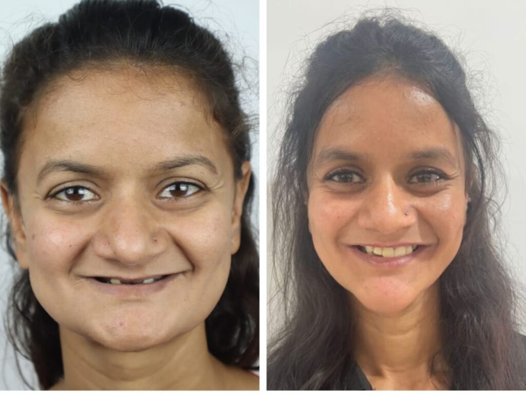 Dental Implants Vs Bridges
