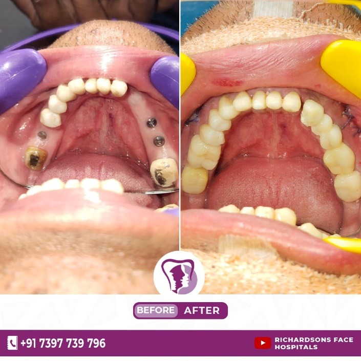 Dental Implants Vs Bridges
