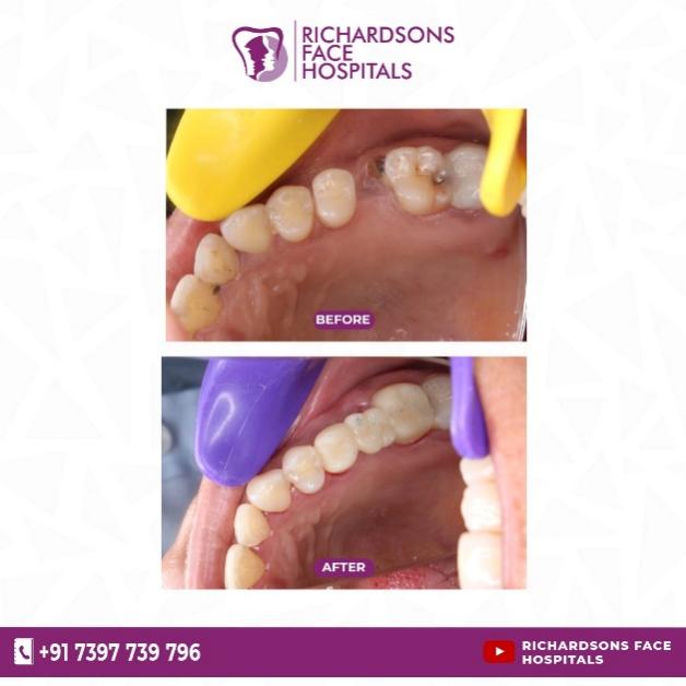 Dental Implants Vs Bridges