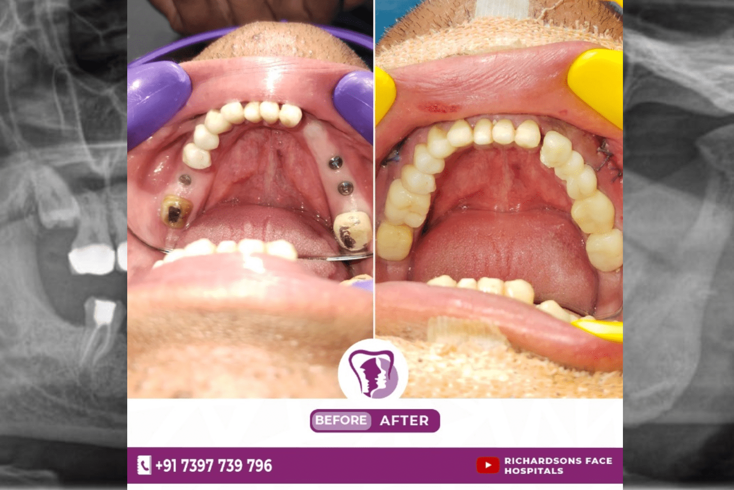 Dental Implants Vs Bridges. Which One Is Right For You?