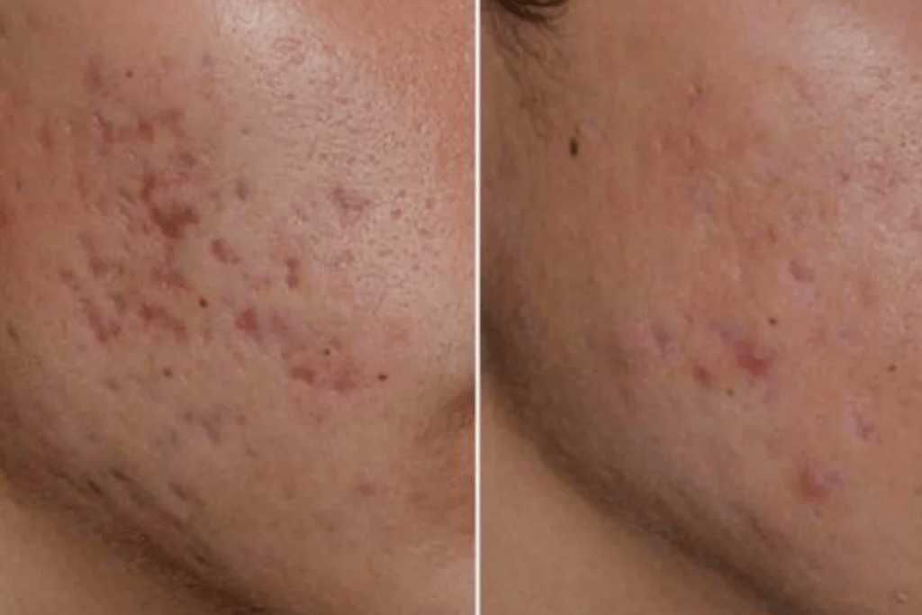 How To Get RID Of Acne Scars Permanently