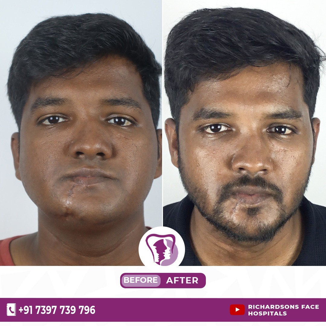 Jaw Contouring surgery