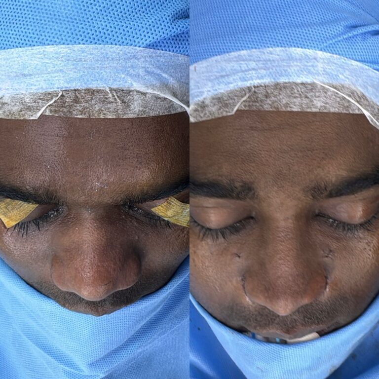Augmentation Rhinoplasty