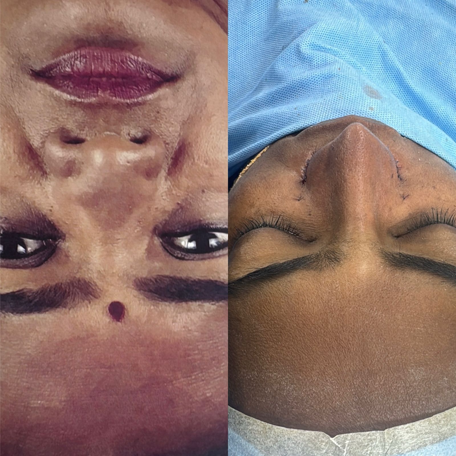 Piezo Rhinoplasty