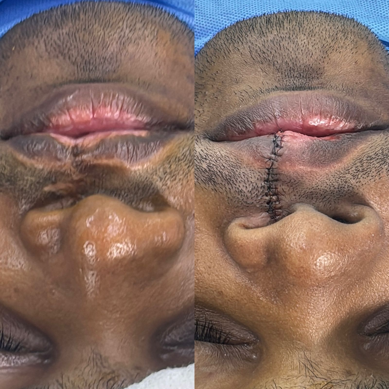 Cleft Lip Revision