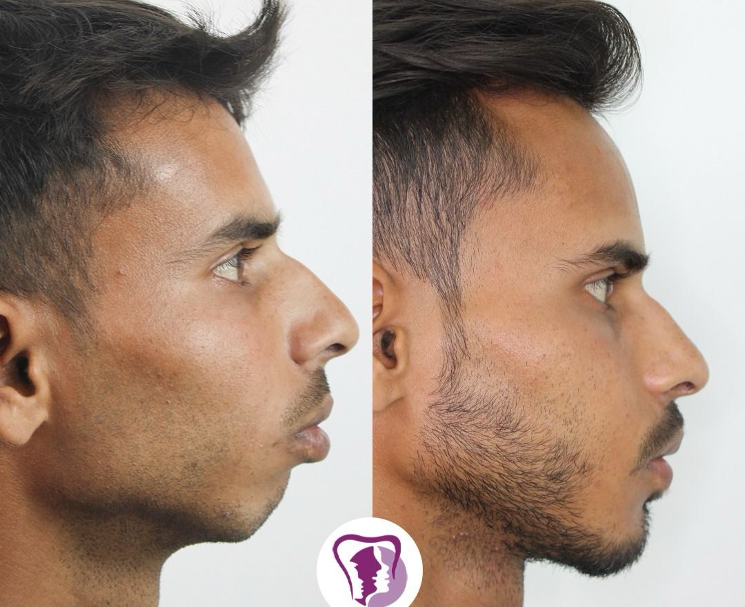 Jaw Contouring surgery