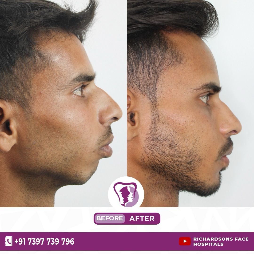 Jaw Contouring surgery