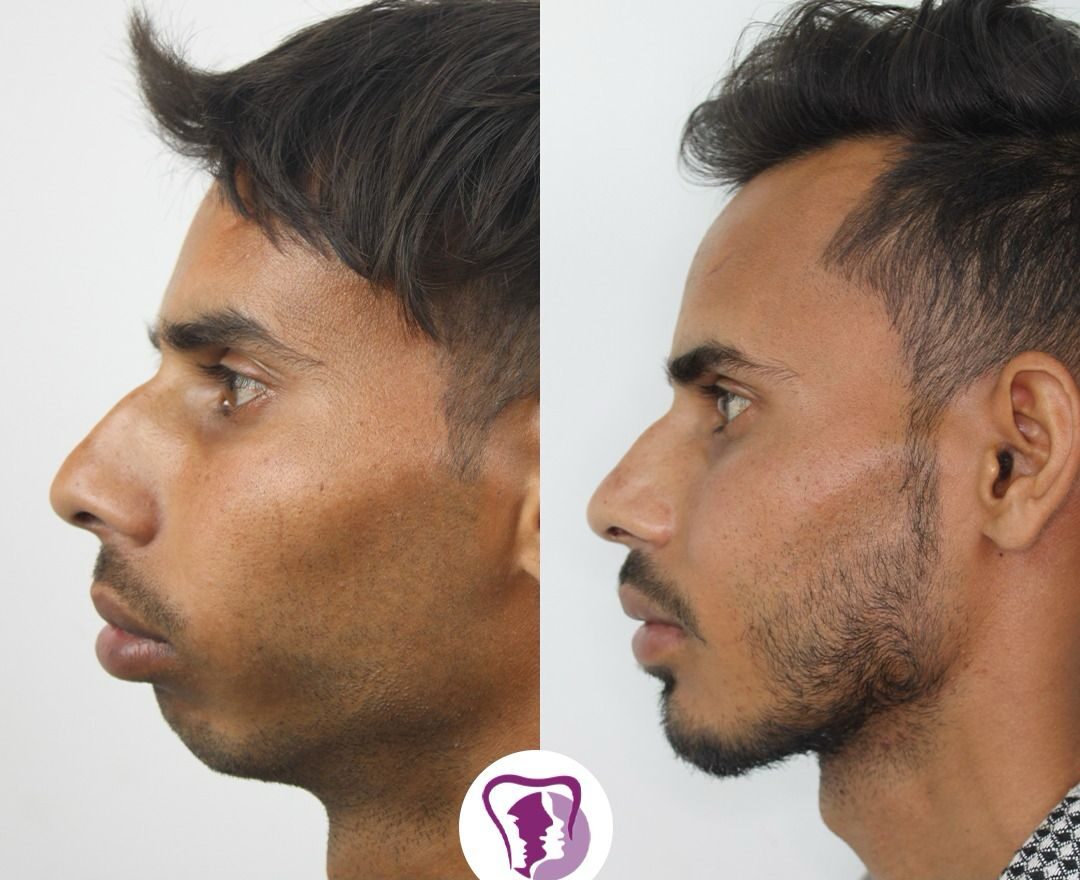 Jaw Contouring surgery